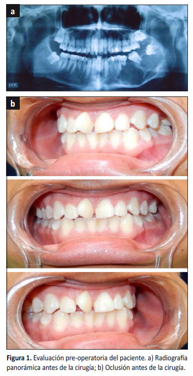Modelo de maxilar y mandíbula afectada por un pecoma_01 - AJL